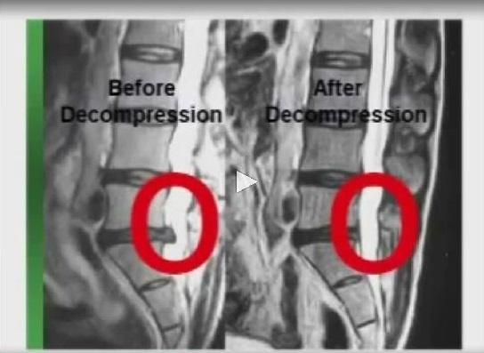 decompression 20comparison